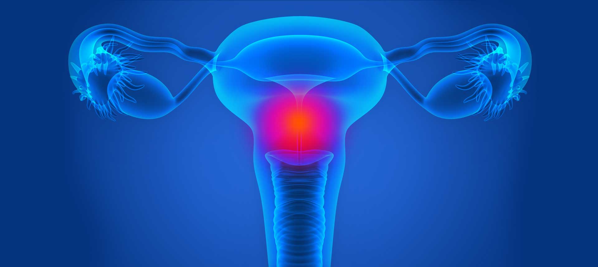 utero (tumore dell'endometrio e tumore della cervice)